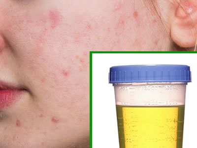 Acne and urine therapy