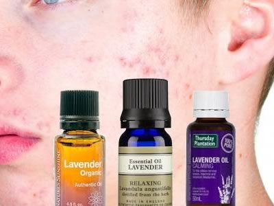 Acne and lavender oil